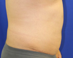Tummy Tuck Before & After Patient #739