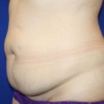 Tummy Tuck Before & After Patient #740