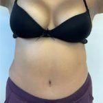 Tummy Tuck Before & After Patient #741
