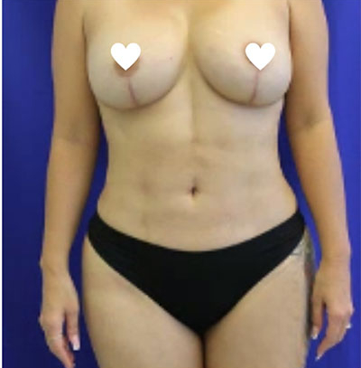 Tummy Tuck Before & After Patient #743