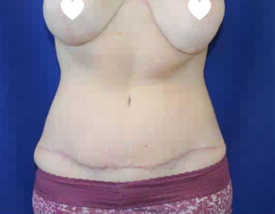 Tummy Tuck Before & After Patient #744