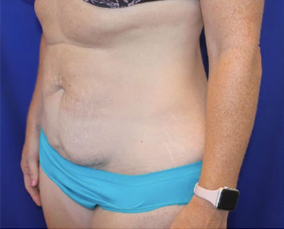 Tummy Tuck Before & After Patient #745