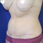 Tummy Tuck Before & After Patient #745