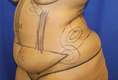 Tummy Tuck Before & After Patient #747