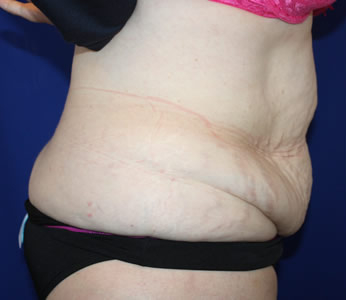 Tummy Tuck Before & After Patient #723