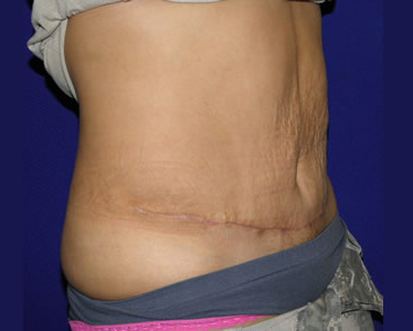 Tummy Tuck Before & After Patient #724