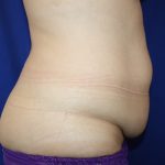 Tummy Tuck Before & After Patient #725