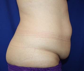 Tummy Tuck Before & After Patient #725