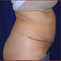 Tummy Tuck Before & After Patient #727
