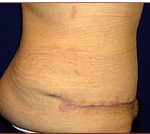 Tummy Tuck Before & After Patient #728