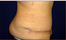 Tummy Tuck Before & After Patient #728