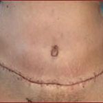 Tummy Tuck Before & After Patient #729