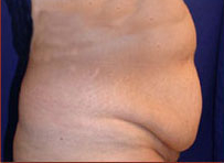 Tummy Tuck Before & After Patient #729