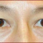 Asian Blepharoplasty Before & After Patient #934