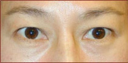 Asian Blepharoplasty Before & After Patient #934