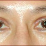 Asian Blepharoplasty Before & After Patient #934