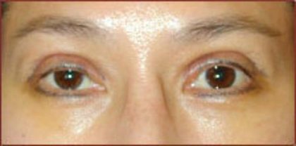 Asian Blepharoplasty Before & After Patient #934