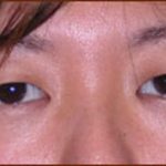 Asian Blepharoplasty Before & After Patient #935