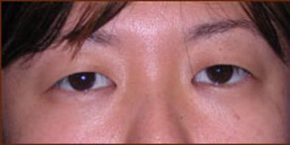 Asian Blepharoplasty Before & After Patient #935