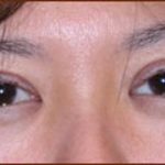 Asian Blepharoplasty Before & After Patient #935