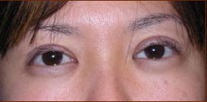 Asian Blepharoplasty Before & After Patient #935