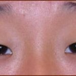 Asian Blepharoplasty Before & After Patient #936