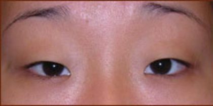 Asian Blepharoplasty Before & After Patient #936