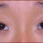 Asian Blepharoplasty Before & After Patient #936