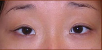 Asian Blepharoplasty Before & After Patient #936