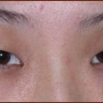 Asian Blepharoplasty Before & After Patient #937
