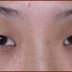 Asian Blepharoplasty Before & After Patient #937