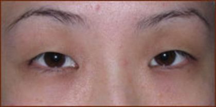 Asian Blepharoplasty Before & After Patient #937