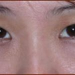 Asian Blepharoplasty Before & After Patient #937