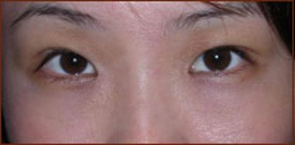 Asian Blepharoplasty Before & After Patient #937