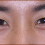 Asian Blepharoplasty Before & After Patient #939