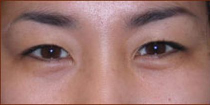 Asian Blepharoplasty Before & After Patient #939