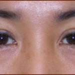 Asian Blepharoplasty Before & After Patient #939