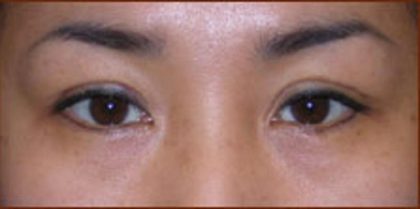Asian Blepharoplasty Before & After Patient #939