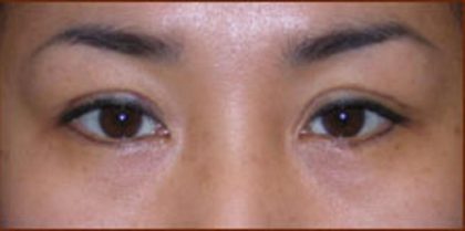 Asian Blepharoplasty Before & After Patient #939