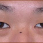 Asian Blepharoplasty Before & After Patient #940