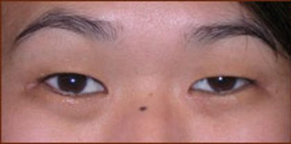 Asian Blepharoplasty Before & After Patient #940