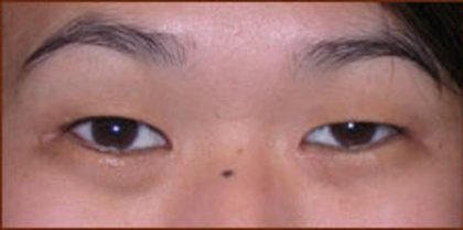 Asian Blepharoplasty Before & After Patient #940