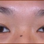 Asian Blepharoplasty Before & After Patient #940