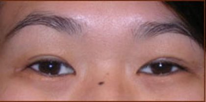 Asian Blepharoplasty Before & After Patient #940