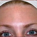 BOTOX® Before & After Patient #1169