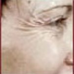 BOTOX® Before & After Patient #1172