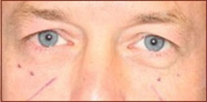 Blepharoplasty Before & After Patient #942