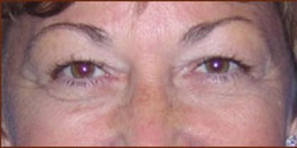 Blepharoplasty Before & After Patient #943