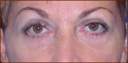 Blepharoplasty Before & After Patient #943