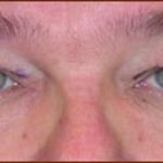 Blepharoplasty Before & After Patient #944
